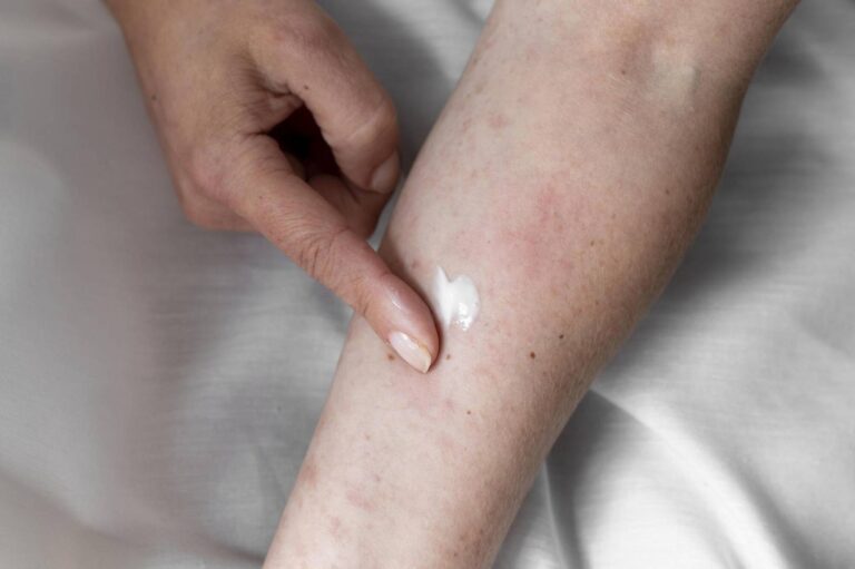 Wysypka alergiczna pokarmowa – przyczyny, objawy i pielęgnacja skóry